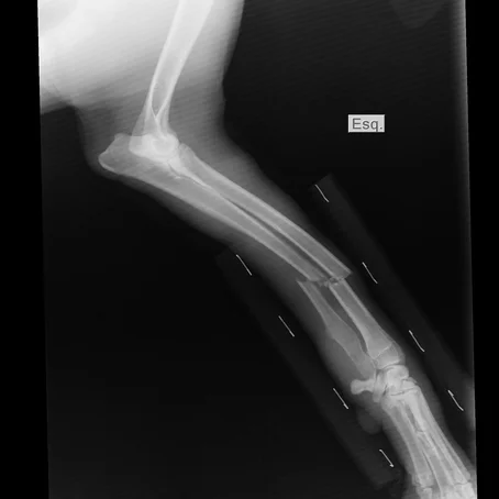 Röntgenfoto van gebroken arm